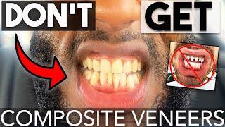 DON'T GET COMPOSITE VENEERS! *UNTIL YOU WATCH THIS* | Composite vs. Porcelain Veneers | COOPSCORNER