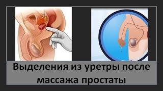 Выделения из уретры после массажа простаты