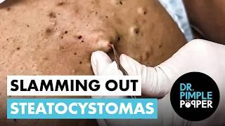 Slamming Out Steatocystomas