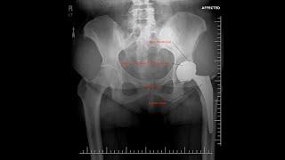 What is a Hip Replacement? Dr. Robert Cagle Explains