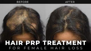 PRP Hair Treatment | Female Hair Loss | Trichotillomania Case Study