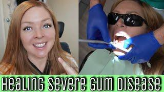 My Experience With SEVERE Gum Disease (Periodontal disease diagnoses, treatments & natural healing)