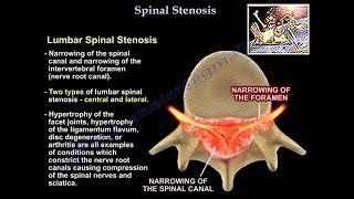 Lumbar Spinal Stenosis - Everything You Need To Know - Dr. Nabil Ebraheim