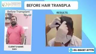 Life-Changing Hair Transplant Journey at Vj clinics| Dr. VJs Cosmetic Surgery & Hair Transplantation