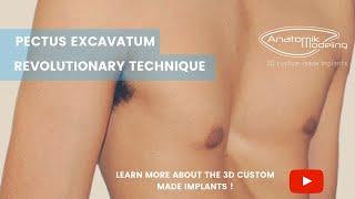 AnatomikModeling - Pectus Excavatum - EN