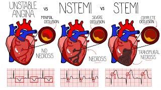 Acute Coronary Syndrome (Heart Attack) - Unstable Angina vs NSTEMI vs STEMI | With ECGs