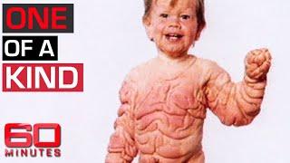 Medical mystery: Boy living with rare excess skin condition | 60 Minutes Australia