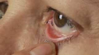 First aid - Eye Injuries