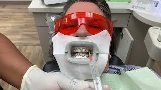 Houston Cosmetic Dentist... Watch this to see how Zoom whitening works! Step by Step:)