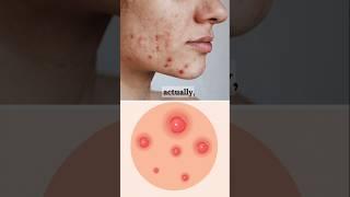 Adult Acne: Myths & Facts #shorts