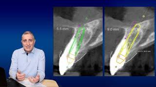 Какой длины должен быть имплант (Длина импланта)