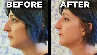 People Get The 5-Minute Nose Job