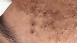 LOOK AT THESE BLACKHEADS ON THE FOREHEAD   PART I #relaxing  #blackheads