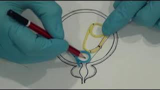 Dalela Triple J stent