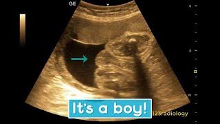 Ultrasound showing boy baby !!!