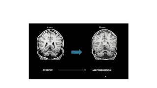 Hind brain for Radiologists with Dr. Sniya Valsa Sudhakar