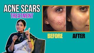 How To Heal Acne Scars | Scars Before and After | Dr. Priyanka Reddy