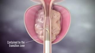 Rezum Treatment for Enlarged Prostate with Dr. Richard Levin