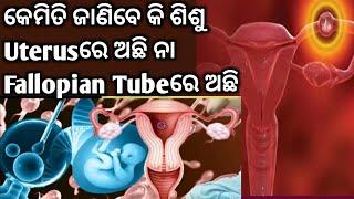 କେମିତି ଜାଣିବେ ଶିଶୁ Uterus ରେ ଅଛି ନା FallopianTube ରେ ଅଛି।Early Pregnancy Symptoms।Ectopic Pregnancy