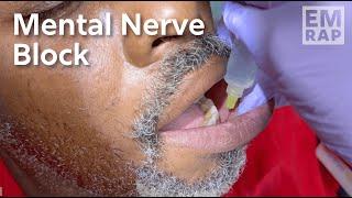 Mental Nerve Block