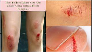 How To Treat Minor Cuts And Grazes Using  Natural Home Remedies