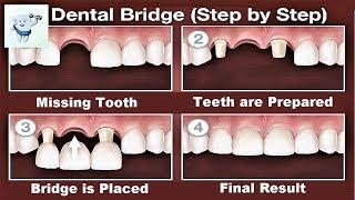 Dental Bridge Procedure Step by Step