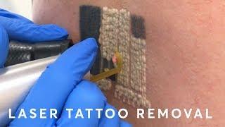 Laser Tattoo Removal: PAIN, RESULTS & PROCEDURE