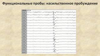 ЭЭГ при эпилепсии (EEG in epileptic patients)