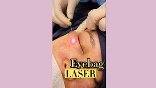 Eye Bag Laser Procedure - Before & After Results | RJ CLINIC