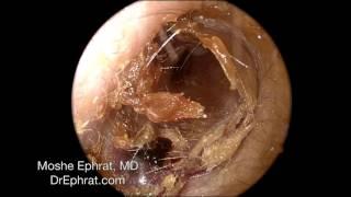 Ear Wax Removal