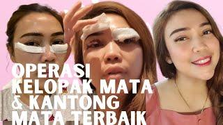 Operasi Kelopak Mata Dan Kantung Mata Nggak Pake Mahal Disini!! Dokternya Senior TerBaik Di Bandung!