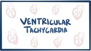 Ventricular tachycardia (VT) - causes, symptoms, diagnosis, treatment & pathology
