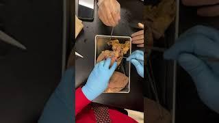 Heart Dissection and Pathology