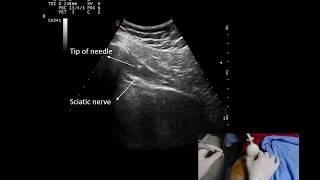 Ultrasound guided piriformis injection, by Murat Karkucak MD