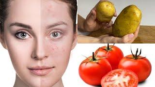 Get rid of acne and pimples quickly with this face mask Recipe # 33