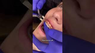 Braces Removal Process | Dr Bar The Braces Doc