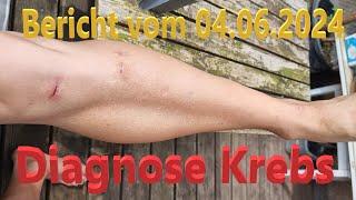 Diagnose KREBS - Bericht vom 05.06.2024