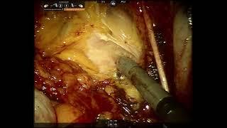 AUA Urology Teaching Videos: Robotic anterior exenteration in females– tips and tricks