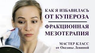 как я избавилась от купероза на лице. что поможет от сосудистых звездочек