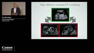 ISUOG 2022 - Prof. Oliver Kagan - 1st trimester anomaly scan beyond normal