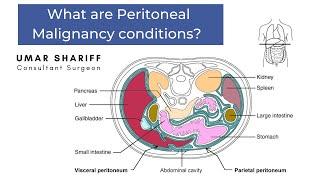 Peritoneal Malignancy conditions