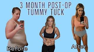 Tummy Tuck 3 Months Post Op: Skin Removal After Weight Loss