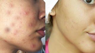 How to Get Rid of Acne in ONE WEEK