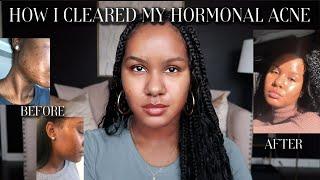 HOW I CLEARED MY HORMONAL ACNE | SKINCARE JOURNEY| NO ACCUNTANE