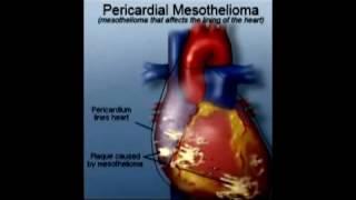 Info About Mesothelioma )) Meso Insurance ((