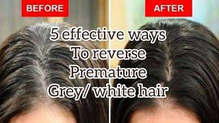 How to reverse premature grey/white hair naturally | Best remedies for premature grey hairs