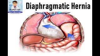 Diaphragmatic hernias / Diaphragm / Hiatal Hernia/Sliding hernia/congenital hernia /Traumatic Hernia