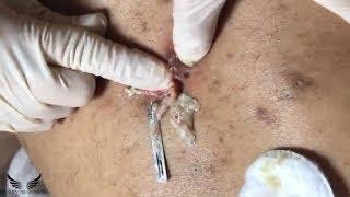 Extraction acné kystique : points noirs, miliums & points blancs - Popping de boutons.