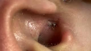 Ear-normous Blackhead Extraction: Giant Blackhead Removed with a Loop Extractor