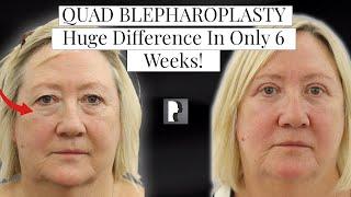 Quad Blepharoplasty Surgery Incredible Difference in only 6 weeks!